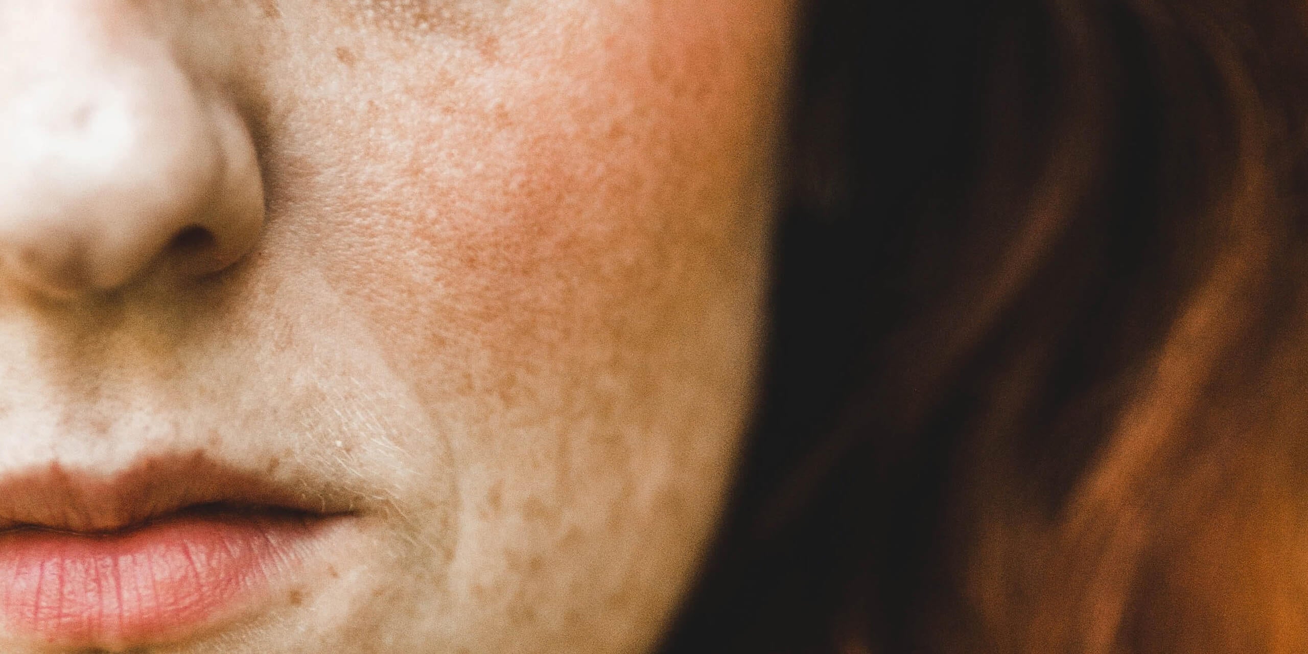 Acido azelaico contro acne e macchie: le proprietà