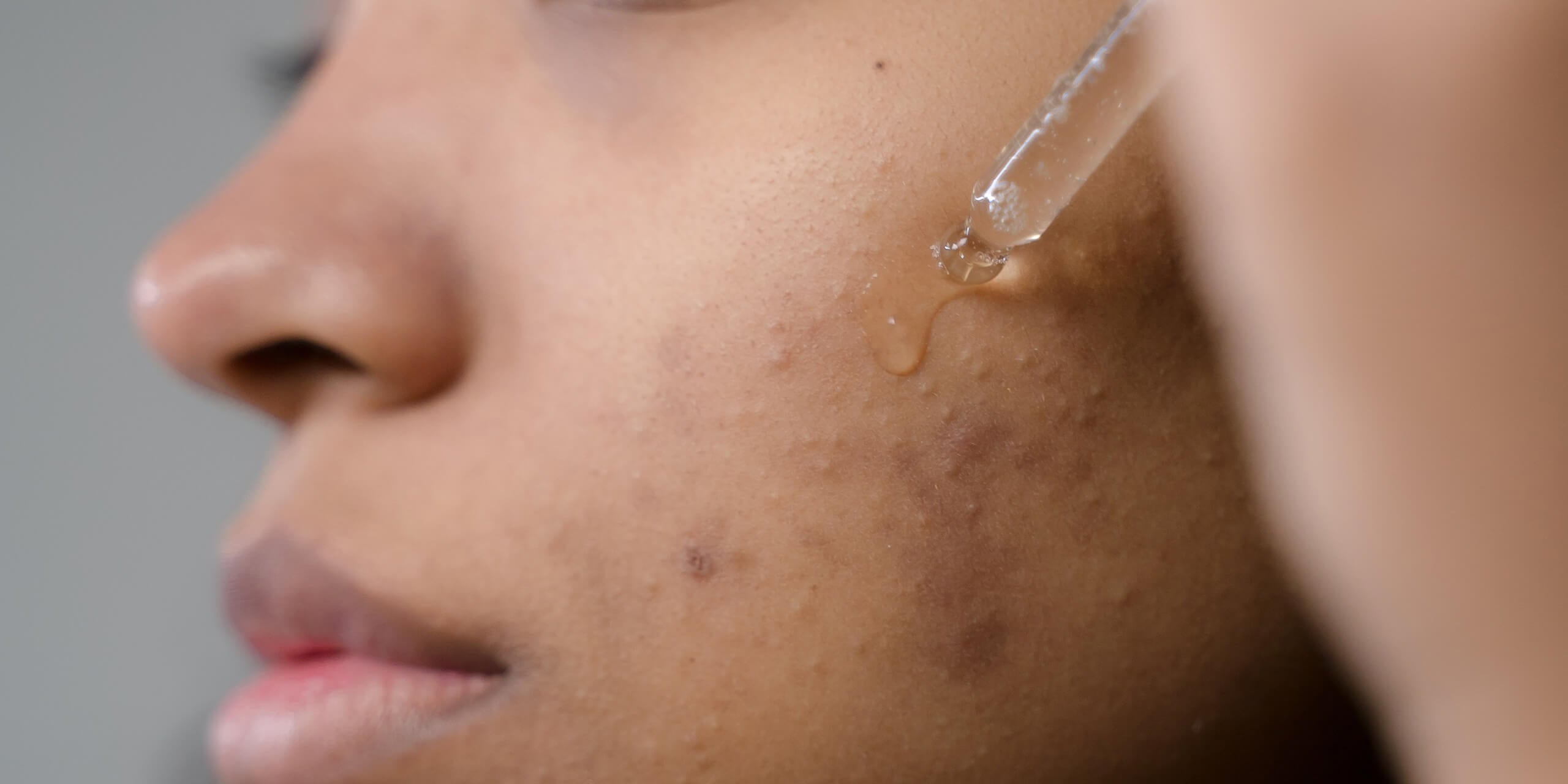 Come curare l'acne